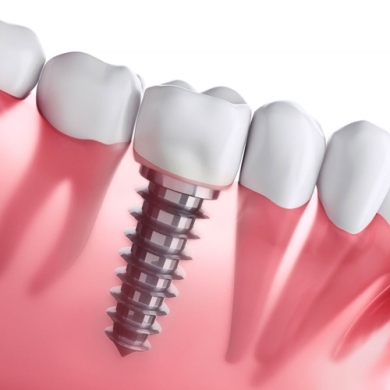 Cấy Ghép Implant Không Đau (Công Nghệ Cao) Tại Nha Khoa DR Tâm – Giải Pháp Trồng Răng Hiện Đại, An Toàn, Êm Ái
