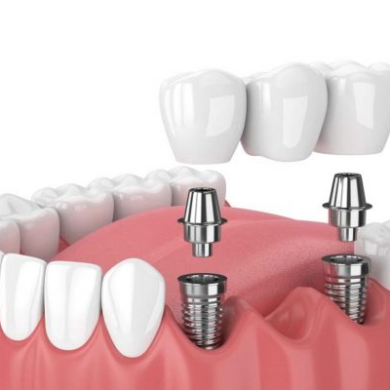 Cấy Ghép Implant Nhiều Răng Tại Nha Khoa DR Tâm – Giải Pháp Phục Hồi Răng Mất Toàn Diện, Bền Chắc Lâu Dài