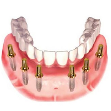 Cấy Ghép Implant Toàn Hàm Tại Nha Khoa DR Tâm – Giải Pháp Phục Hồi Răng Mất Toàn Diện, Bền Chắc Suốt Đời
