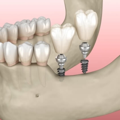 Cấy Ghép Implant Mini Tại Nha Khoa DR Tâm – Giải Pháp Trồng Răng Nhanh, Ít Xâm Lấn, Chi Phí Tiết Kiệm