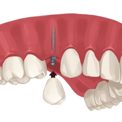Phục Hình Trên Implant Tại Nha Khoa DR Tâm – Hoàn Thiện Răng Đẹp Tự Nhiên, Ăn Nhai Bền Chắc