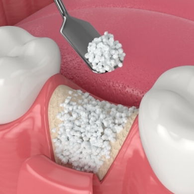 Cấy Ghép Implant Có Ghép Xương Tại Nha Khoa DR Tâm – Giải Pháp Cho Trường Hợp Tiêu Xương, Mất Răng Lâu Năm