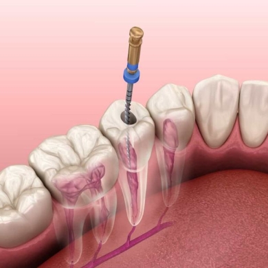 Điều Trị Tủy Răng – Giải Pháp Loại Bỏ Đau Nhức, Bảo Tồn Răng Thật Hiệu Quả