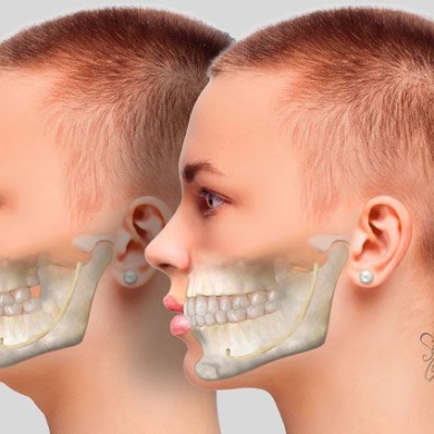 Phẫu Thuật Chỉnh Hàm Hô, Móm, Mặt Lệch – Giải Pháp Thẩm Mỹ Khuôn Mặt Toàn Diện
