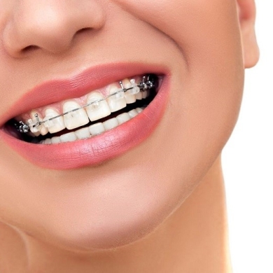Niềng Răng Mắc Cài Sứ (Thẩm Mỹ) Tại Nha Khoa DR Tâm – Giải Pháp Chỉnh Nha Tinh Tế, Hiệu Quả Cao