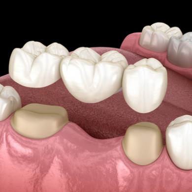 Phục Hồi Răng – Giải Pháp Khôi Phục Chức Năng Và Thẩm Mỹ Nụ Cười Toàn Diện