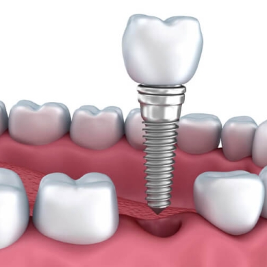 Nhổ Răng Kết Hợp Cấy Ghép Implant Tại Nha Khoa DR Tâm – Giải Pháp Nhổ & Trồng Răng Ngay, Nhanh Chóng – Thẩm Mỹ – Bền Lâu